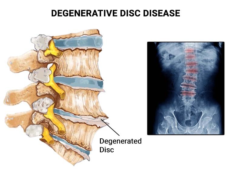 Thoracic-Degenerative-Disc-Disease