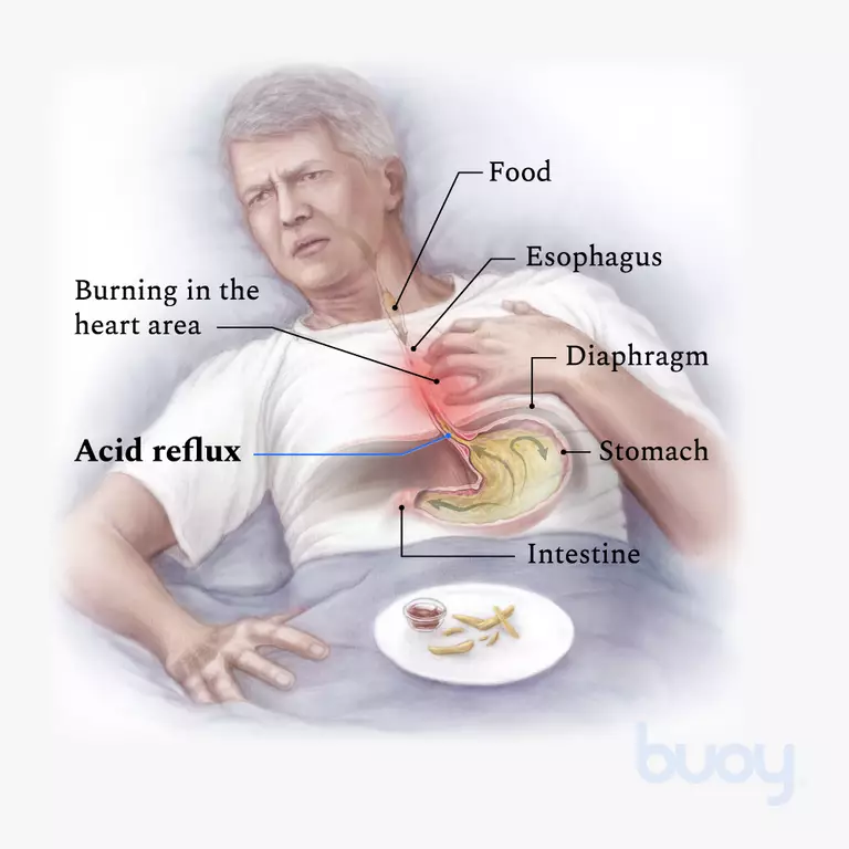 acid reflux