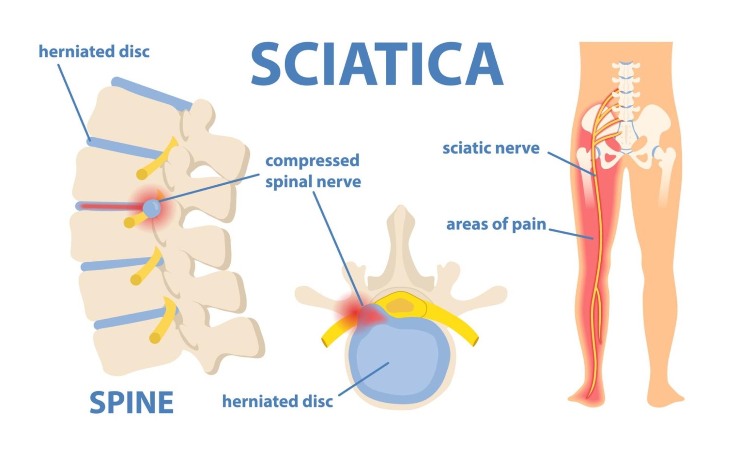 benchmark-physio-sciatica-diagram-1536x922