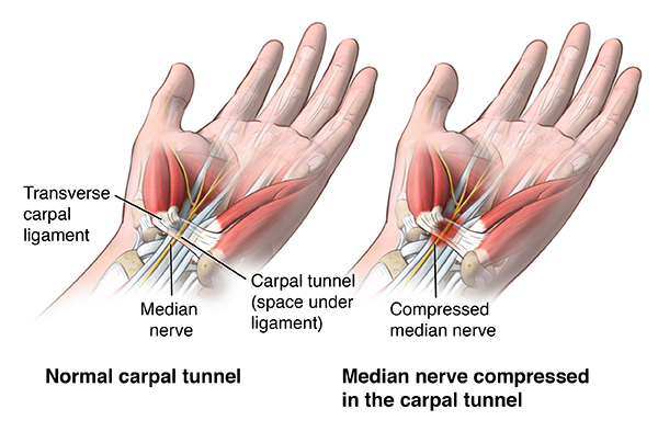 Anterior view of wrist comparing a healthy carpal tunnel with a compressed median nerve in the carpal tunnel; AMuscsk_20140312_v0_003;

SOURCE: ortho_carp-tun-rel-endo_anat.ai
